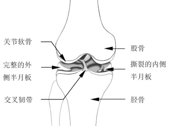 △受损的半月板